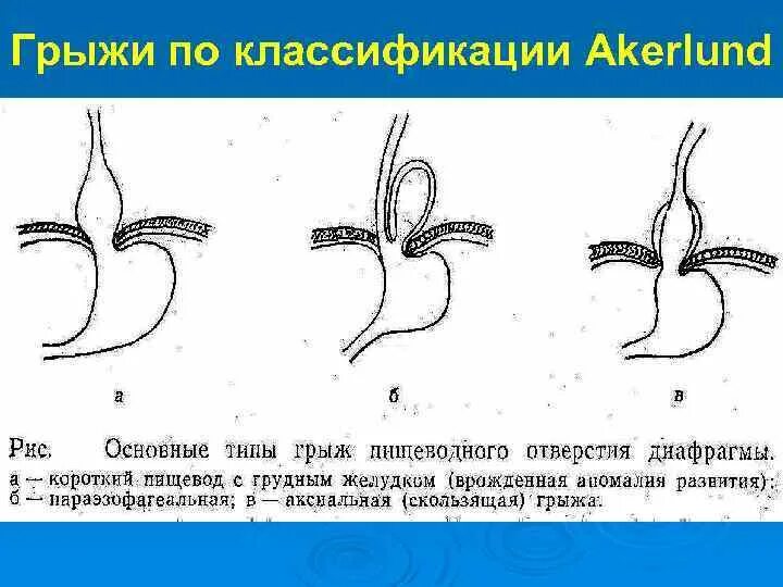 Классификация грыж пищеводного отверстия. ГПОД классификация рентгенологическая. Грыжи пищеводного отверстия диафрагмы классификация. Грыжа пищеводного отверстия 1-й степени.