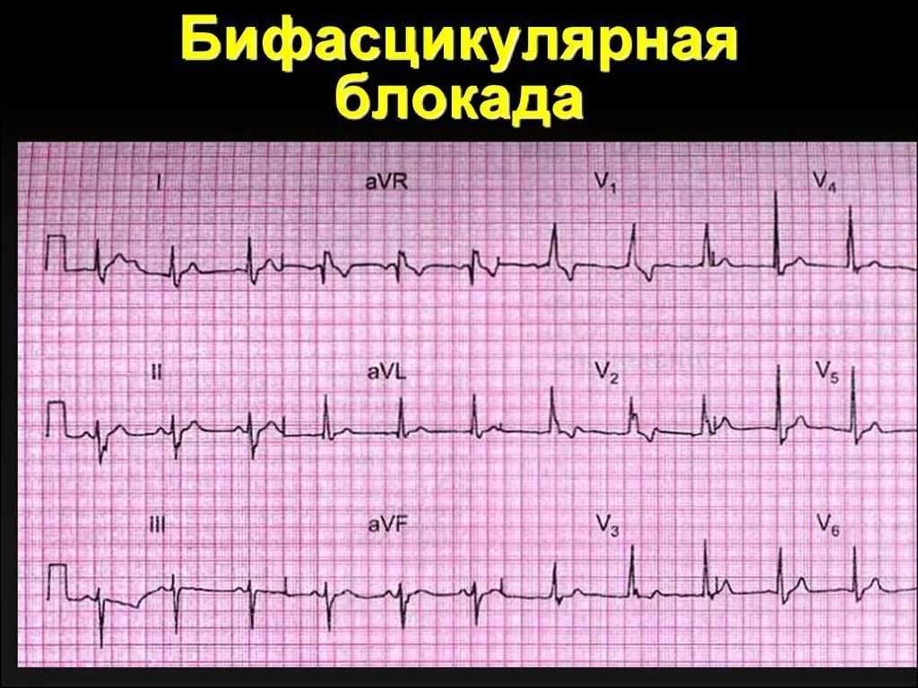 Блокада передне верхнего разветвления пучка гиса. Блокады на экг. двухпучковая блокада на экг. бифукцилярная блокада. бифасцикулярная блокада.