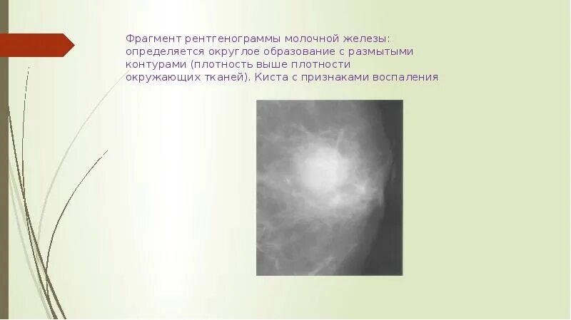 Типы плотности молочных желез в. Типы плотности молочных желез в