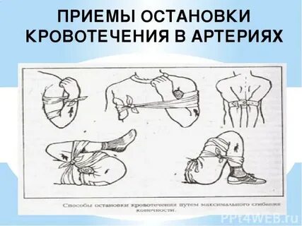 Первая помощь при кровотечении 8 класс