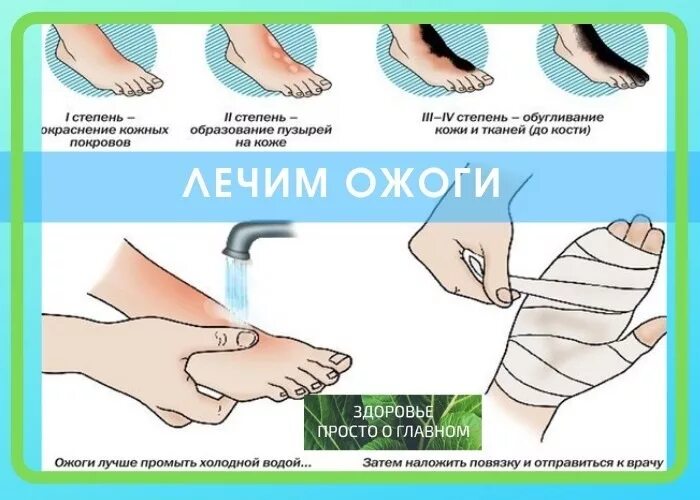 Обработка ожогов водой. Чем быстро вылечить ожог.