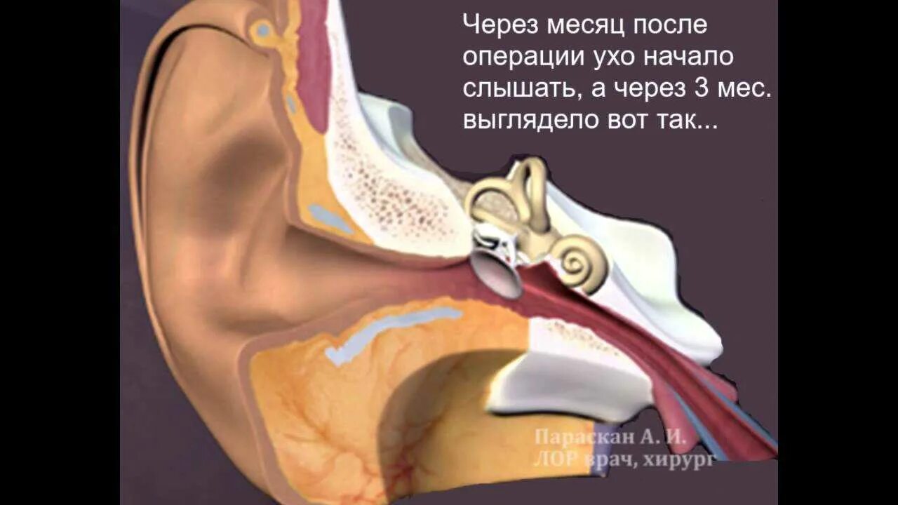 Тимпанопластика барабанной перепонки уха. Тимпанопластика холестеатома. Тимпанопластика уха холестеатома. Хронический отит операция тимпанопластика.