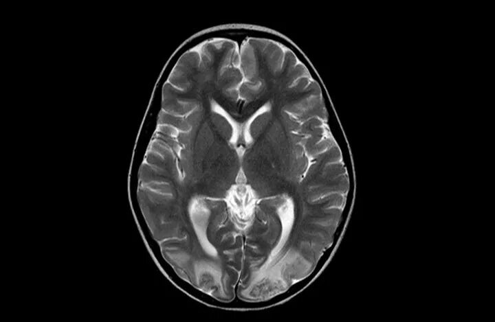 Норма желудочков мозга у взрослых. Боковые желудочки головного мозга на мрт. Асимметрия головного мозга мрт. Гидроцефалия желудочков головного мозга. Гидроцефалия снимок мрт.