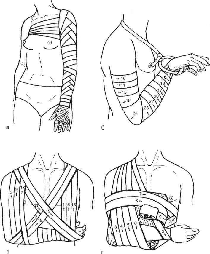 Операция привязки. Перевязка кисти эластичным бинтом. Колосовидная перевязка. Колосовидная повязка на предплечье. Перевязка плеча эластичным бинтом.