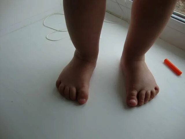 Ножки в 6 месяцев. Паралитическая косолапость. Загнутые пальцы на ногах у ребенка. Ребенок подгибает пальцы на ногах.