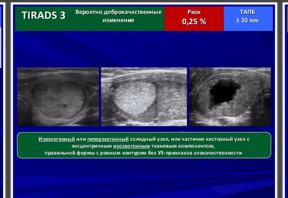 Ti rads 3 в щитовидной. Ультразвуковая эластография щитовидной железы. Ti rads щитовидной железы. Узловые образования щитовидной железы ti-rads 2. Солидные образования щитовидной железы на УЗИ.