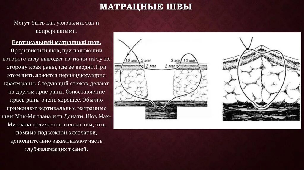 Матрацный шов в хирургии. Непрерывный горизонтальный матрацный шов. вертикальный матрацный шов по донати. матрацный шов техника наложения. горизонтальный и вертикальный матрацный шов.