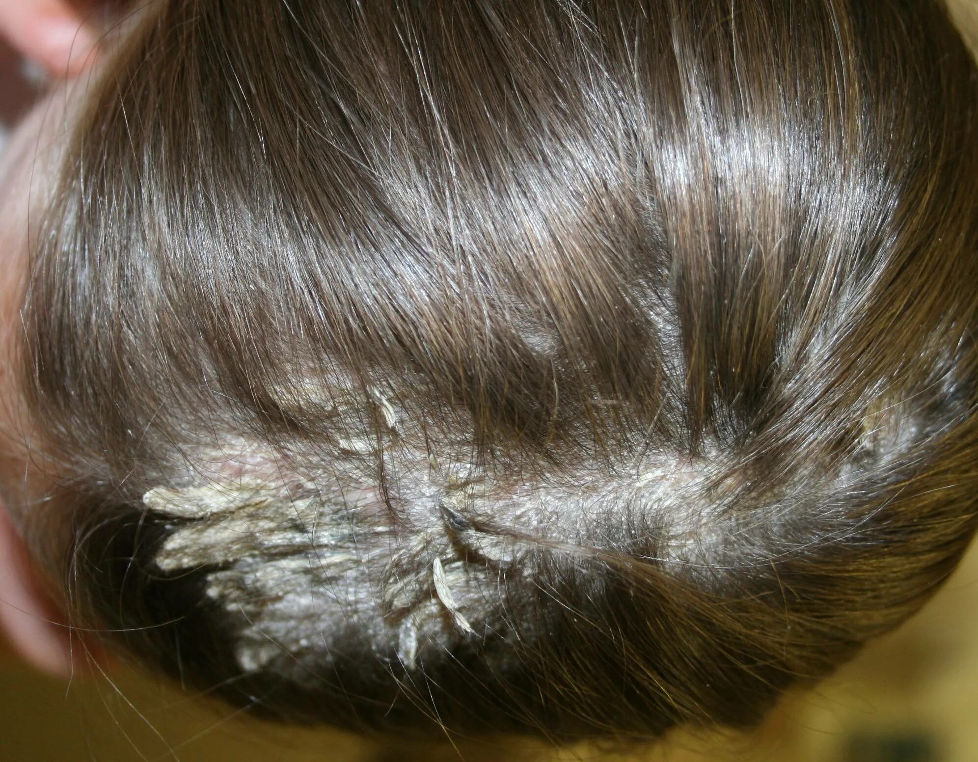 Почему чешется голова и выпадают. Асбестовидный себорейный дерматит. Себорейный дерматит волосистой части головы.