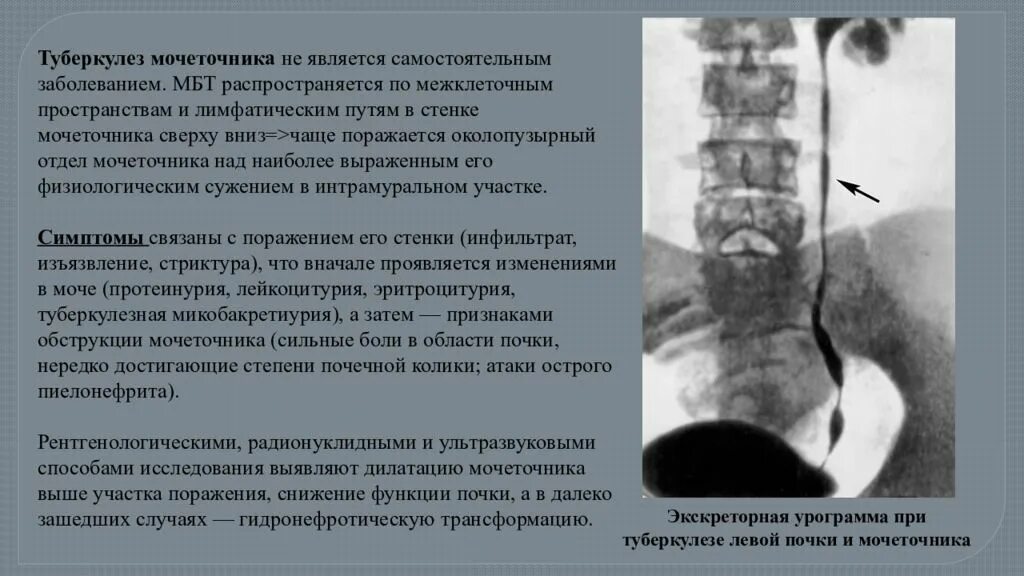 Стриктура мочеточника рентген. Стеноз мочеточника рентген. Интрамуральное сужение мочеточника. Сужение мочеточника рентген. Боли в области мочеточника