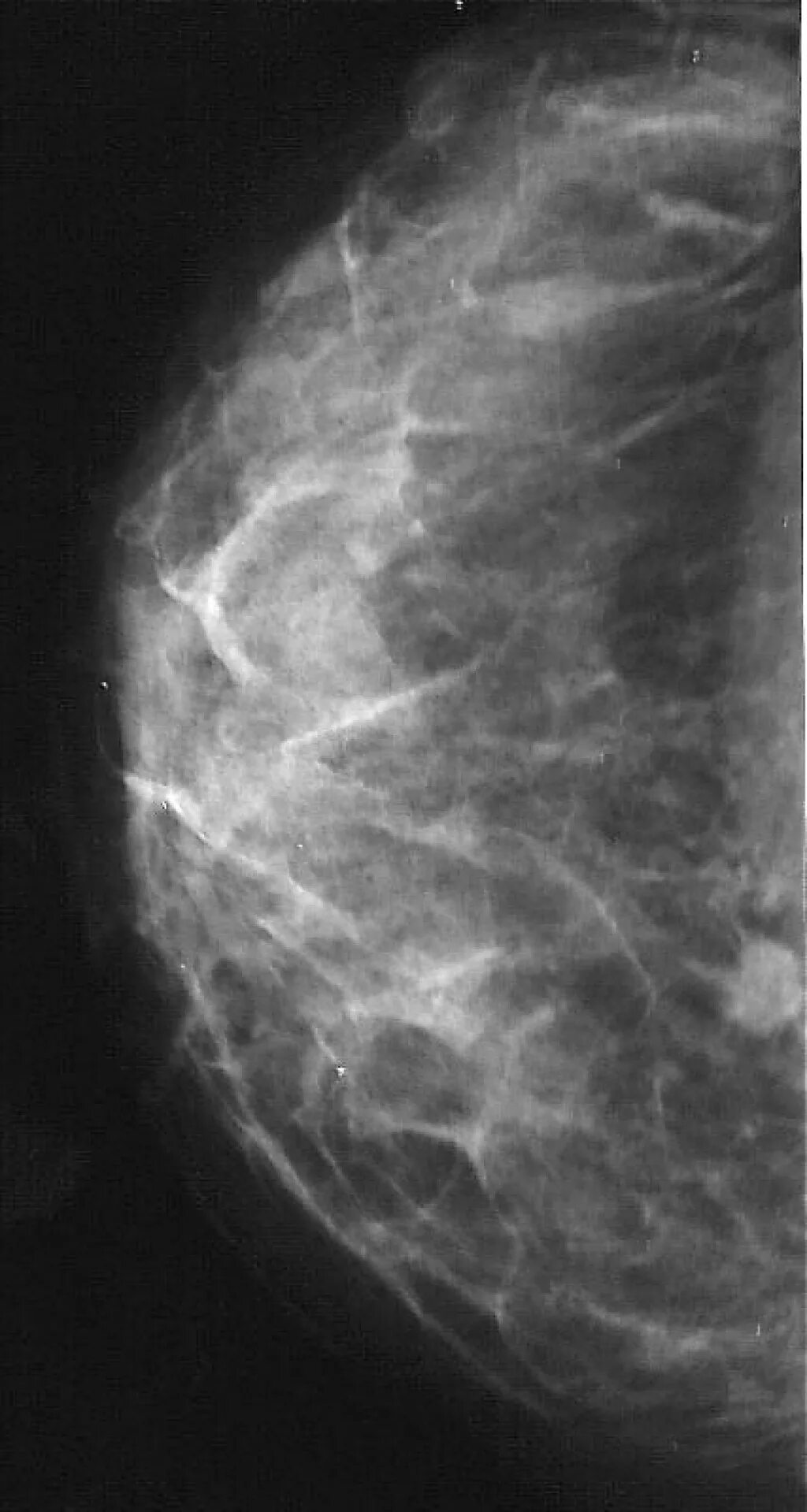 Лимфоузел на маммографии. Киста молочной железы на маммографии. Лимфоузел железы на маммографии.