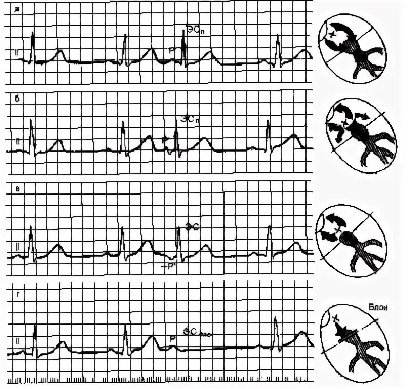 Предсердные экстрасистолы на ЭКГ. Предсердная экстрасистола на стандартной ЭКГ. Блокированная предсердная экстрасистола по ЭКГ. Предсердная экстрасистола через цикл. Экстрасистолы лежа