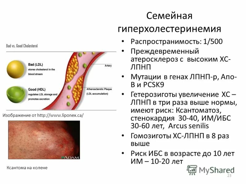 Наследственная гиперхолестеринемия