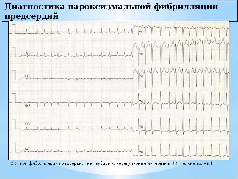 Персистирующая фп. Пароксизм фибрилляции предсердий на экг. пароксизмальная фибрилляция предсердий на экг. персистирующая фибрилляция предсердий экг. пароксизмальная форма фибрилляции предсердий экг.