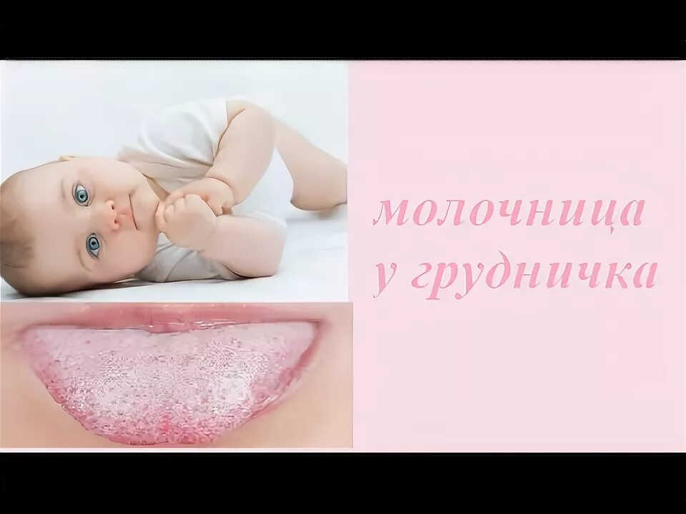 Симптомы молочницы при гв