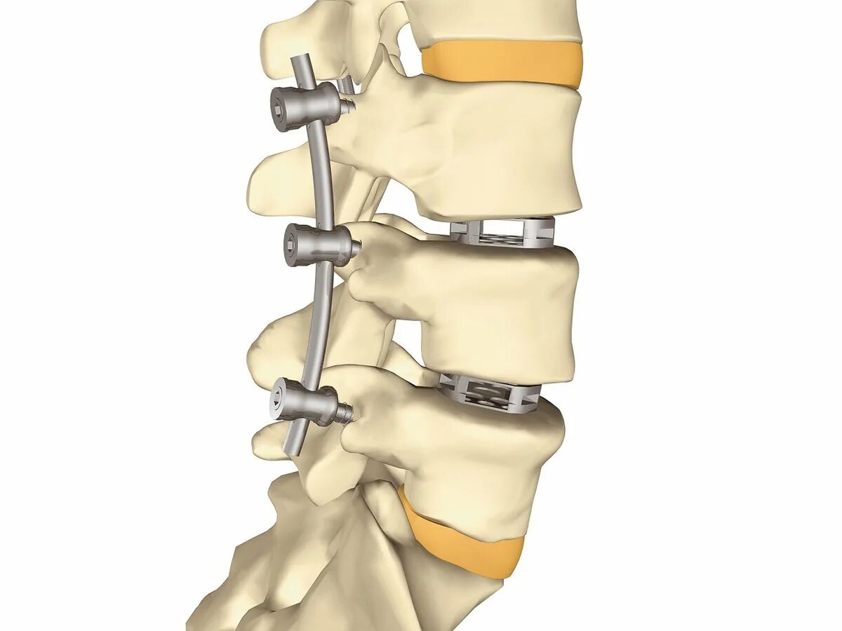 Ретролистез l2 l3 l4. Транспедикулярная фиксация l5-s1. ТПФ l5-s1 системой Кейдж. Задний спондилодез l5 l6. Конструкция позвоночника операция