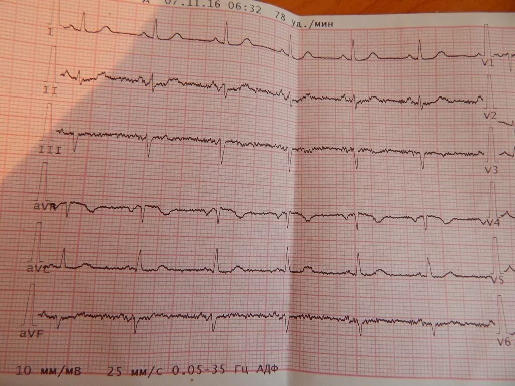 Нормальная кардиограмма здорового человека. ЭКГ электрокардиограмма сердца. Кардиограмма ЭКГ здорового человека. ЭКГ больного человека. Тяжелое экг