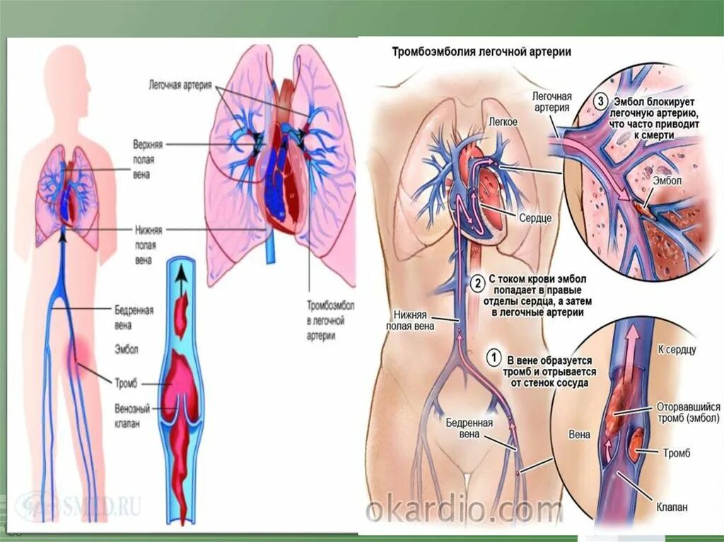 Тромбоэмболия легочной артерии. Периферическая тромбоэмболия. Тромбоэмболия артерии. Омбоэмболия лёгочной артерии. Тромболия легочной артерии
