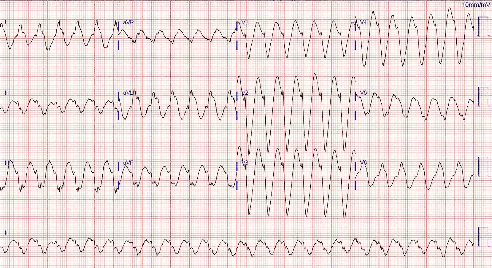 Тахикардия qrs. Желудочковая тахикардия с широкими комплексами на экг. желудочковая тахикардия на экг. тахикардия с широкими комплексами qrs. тахикардия с широкими комплексами qrs на экг.