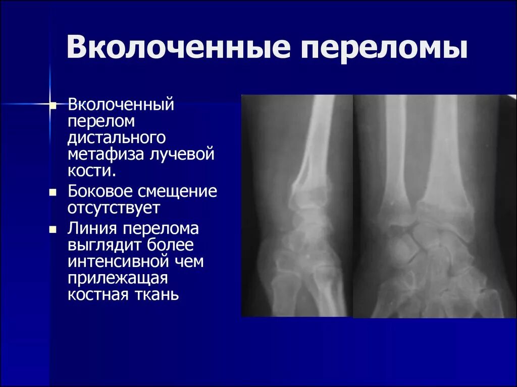 Перелом дистального метафиза лучевой. Вколоченный перелом метаэпифиза лучевой кости. Перелом лучевой кости со смещением рентген. Вколоченный перелом рентген.