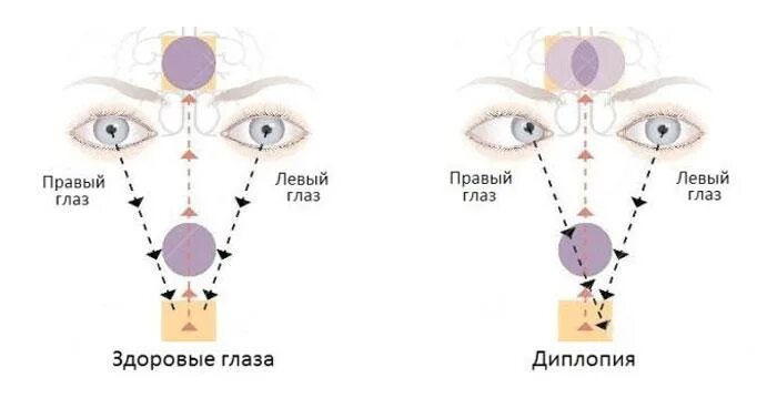 Двоение в глазах лечение. Нарушение зрения диплопия. Бинокулярная диплопия причины. Вертикальная диплопия причины. Двоение в глазах диплопия.