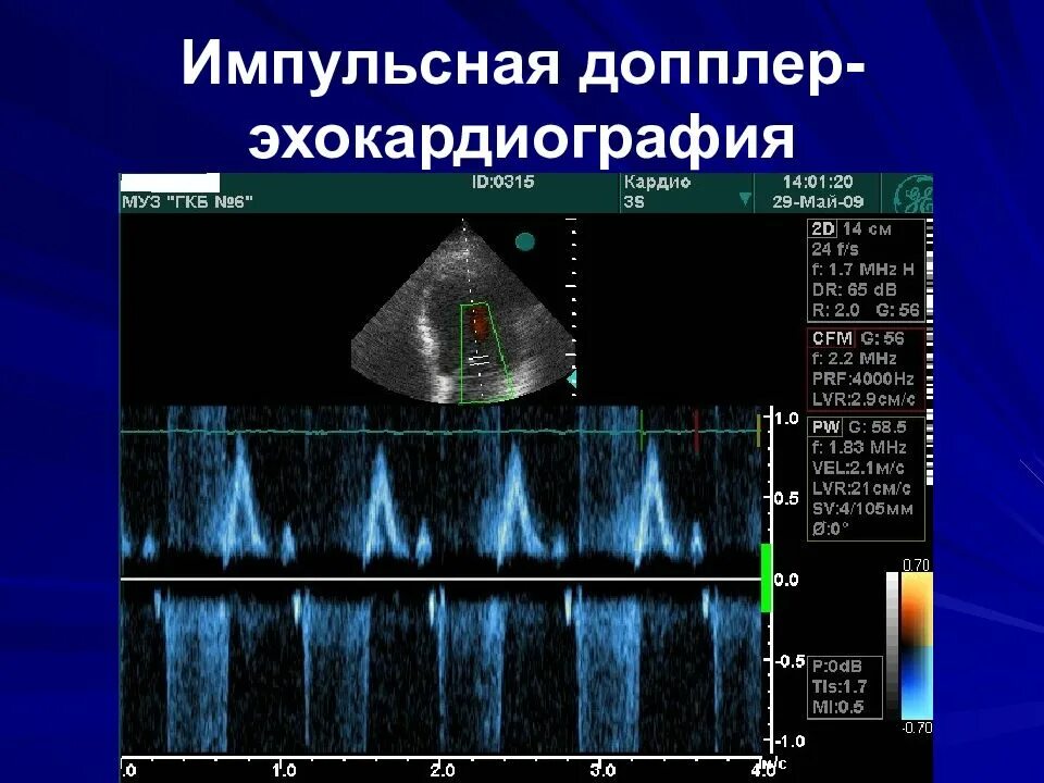 Эхо кардиография. Тканевой допплер в клинической эхокардиографии Алехин. Тканевой импульсно-волновой допплер. Методика проведения эхокардиографии. Эхокардиография с допплеровским исследованием.