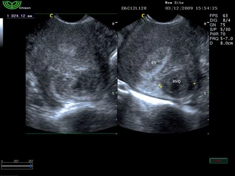 Фиброма малого таза на УЗИ. Фибромиома шейки матки на УЗИ. Рак матки на узи виден