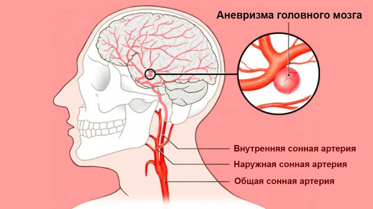 Головная боль сосуды головы. Аневризма артерии головного мозга. Аневризма среднемозговой артерии. Аневризм сонной артерии головного мозга. Аневризма ВСА головного мозга.