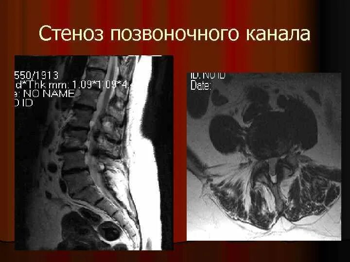 Поясничный абсолютный стеноз