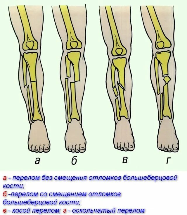 Сколько заживает бедро. Деформация при переломе большеберцовой кости. Оскольчатый перелом диафиза большеберцовой кости. Перелом диафиза костей голени. Перелом малой берцовой кости.