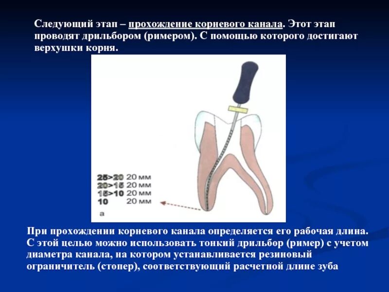 Проходимые корневые каналы