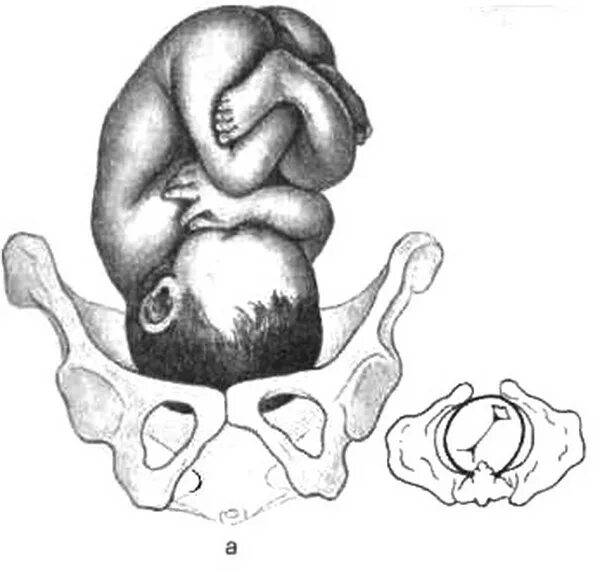 Первое предлежание плода. Задний вид затылочного предлежания биомеханизм родов. Затылочное предлежание плода передний вид. Задний вид затылочного предлежания стреловидный шов. Биомеханизм родов при заднем затылочном предлежании плода.