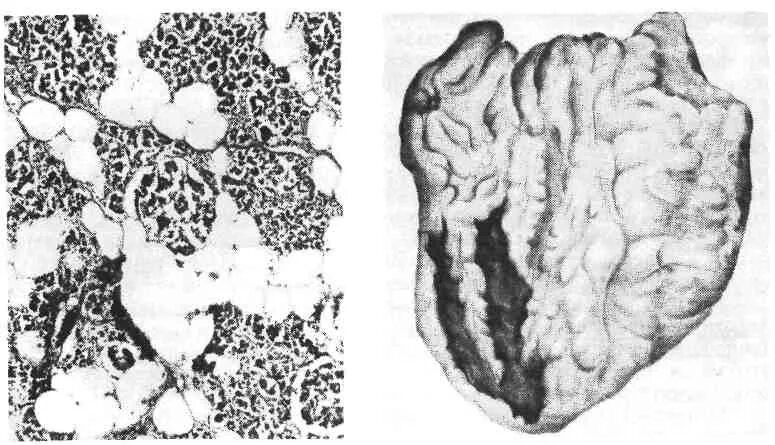 Хронический идиопатический миелофиброз. Патологическое разрастание тканей. Цирроз печени гистология. Патологическое разрастание тканей. Первичный миелофиброз гистология.