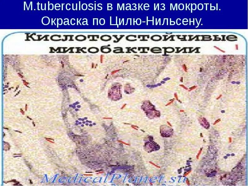 Палочка Коха по Цилю-Нильсену. Микобактерии туберкулеза в мокроте окраска по Цилю Нильсену. M. tuberculosis в мокроте окраска по Циль-Нильсену. Метод Циля-Нильсена микроскопия.