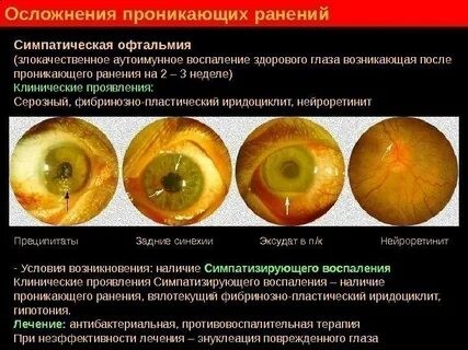 Симпатическая офтальмия это