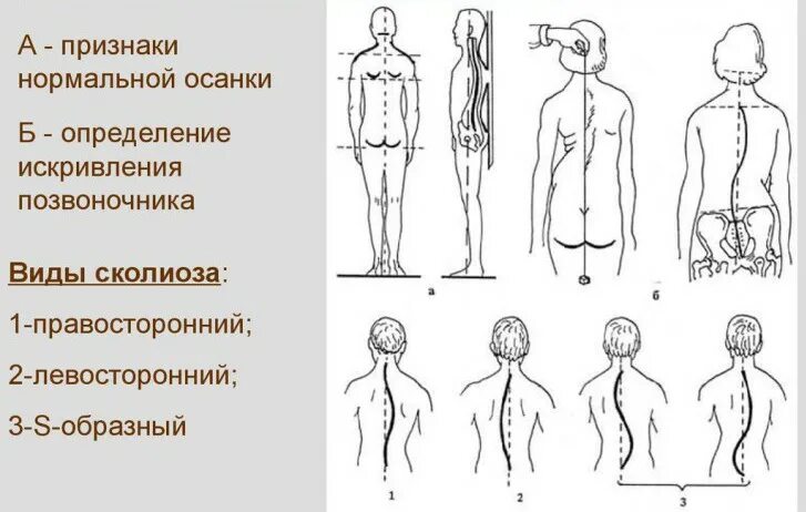 Сколиоз классификация правосторонний. S образный грудопоясничный сколиоз 2 степени массаж. Правосторонний сколиоз 2 степени. Правосторонний сколиоз признаки. Правосторонний сколиоз признаки.