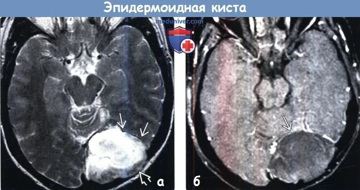 Кистозная аденома гипофиза мрт. Киста верхнечелюстной пазухи на кт снимок. Опухоль головного мозга снимок мрт. Цистаденокарцинома яичника мрт. Киста кармана ратке мрт снимок.