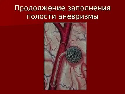 Заполнение полостей