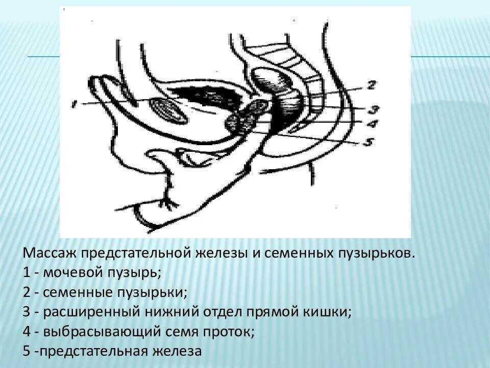 Схема выполнения массажа простаты. Массаж простаты схема проведения. Схема массажа простаты пальцем. Правильная методика массажа простаты.