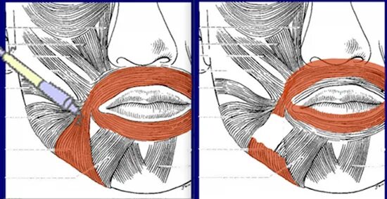 Губы мышцы рта. Что такое резекция Дао(мышц опускающих уголки рта). Мышца опускающая уголки рта.
