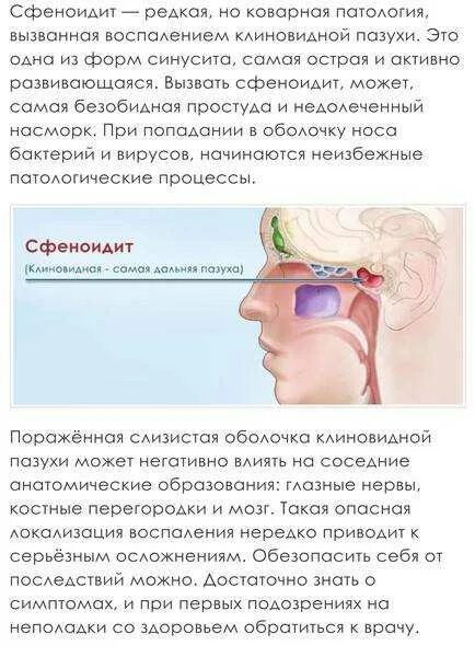 Симптомы синусита решетчатого лабиринта. Этмоидит симптомы и лечение у взрослых. Хронический гнойный этмоидит. Этмоидит на рентгене описание. Хронический гнойный этмоидит.