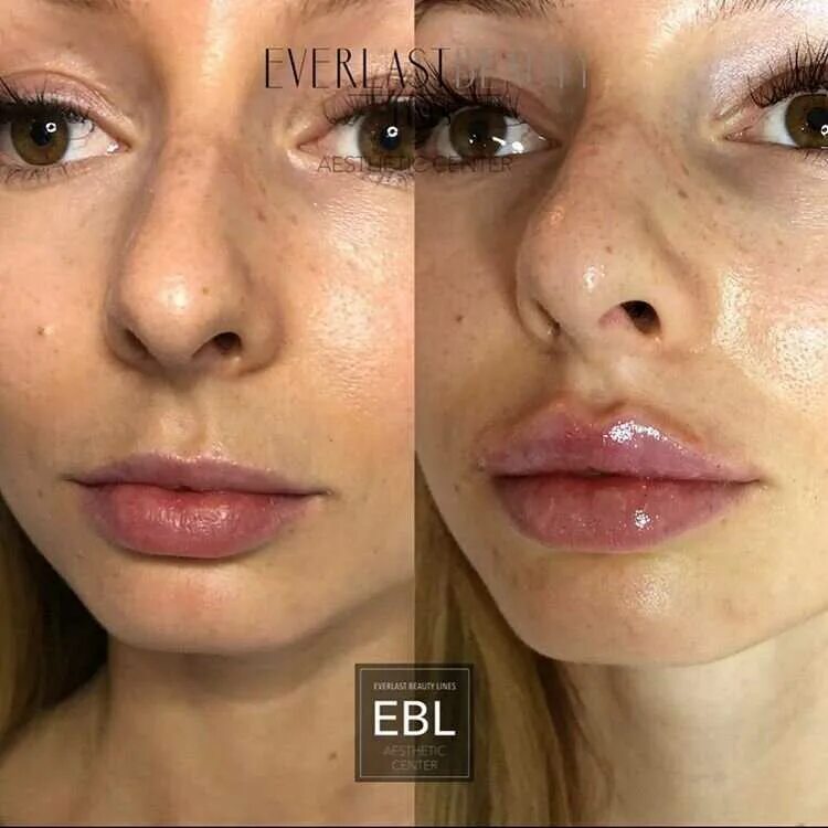 Нижняя треть лица. Гиалуроновый валик над губой. Форма губ для увеличения. Валик над губой после филлера. Губы после контурной пластики.