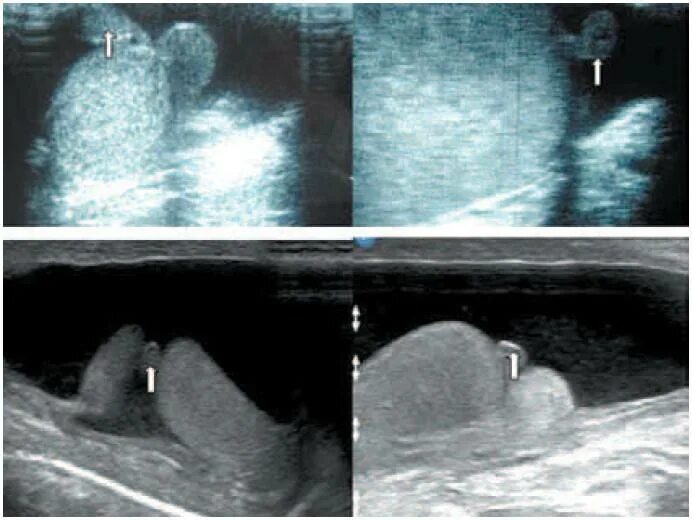 Увеличено яичко у мальчика. Гидатида яичка операция. Гидатида семенного канатика. Перекрут гидатиды яичка на УЗИ. Гидатида придатка яичка на УЗИ.