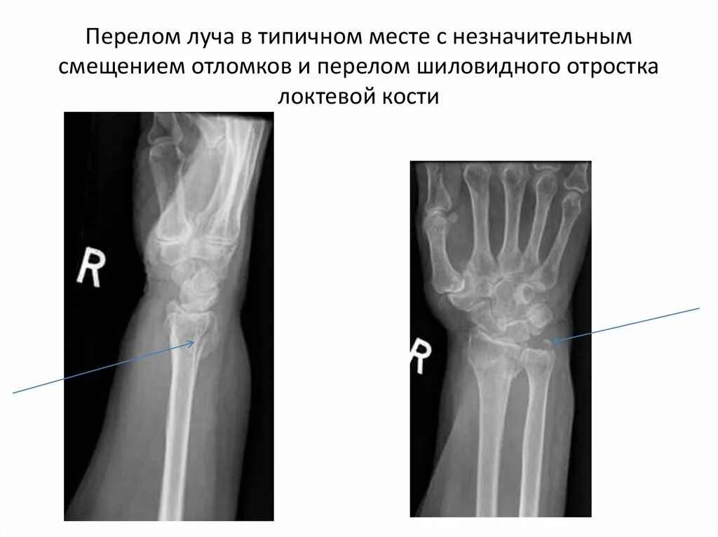 Диагноз перелома лучевой кости. Перелом лучевой кости рентген. Рентген лучезапястный сустав перелом лучевой кости. Перелом Смита лучевой кости. Перелом лучевой кости предплечья.