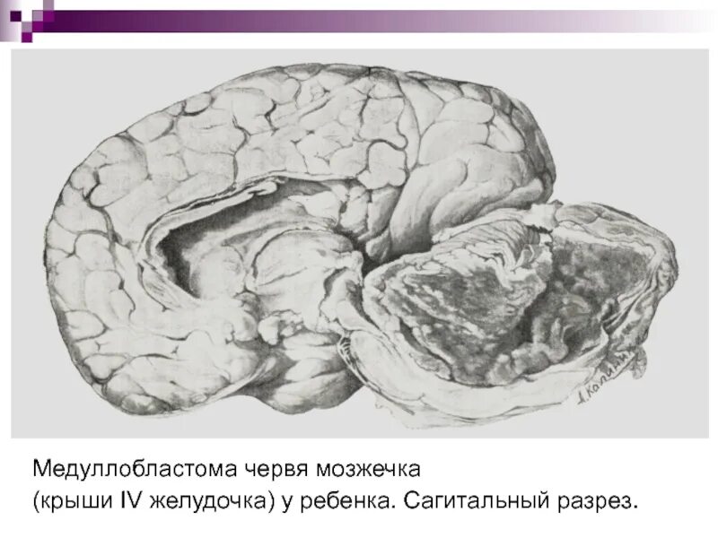 Медуллобластома это. Анапластическая медуллобластома. медуллобластома головного мозга у детей. медуллобластома червя мозжечка. медуллобластома червя мозжечка у детей.