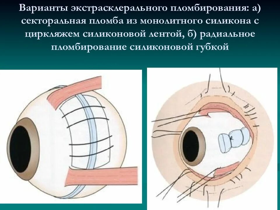 Циркляж