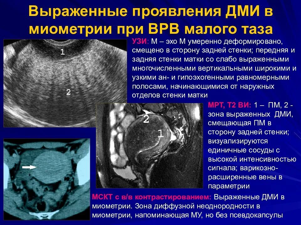 Расширение вен малого таза по УЗИ. Варикозное расширение вен малого таза по УЗИ. Расширение вен миометрия на УЗИ. Варикозное расширение вен матки на УЗИ. Что значит расширенная матка