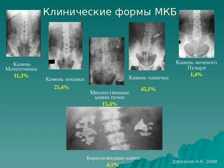 Мочекаменная болезнь лекция
