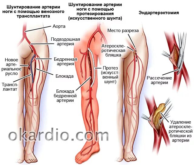 Операция на артерии нижних