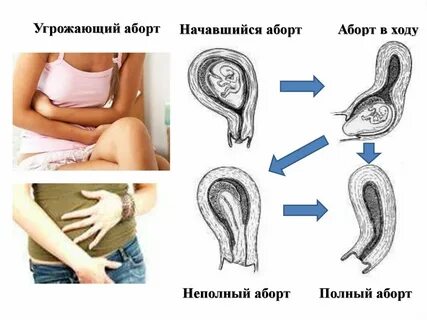 Этапы выкидыша