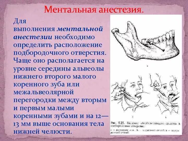 Анестезия на латинском. Ментальная анестезия нижней челюсти. Внутриротовая Ментальная анестезия. Внеротовой способ ментальной анестезии.